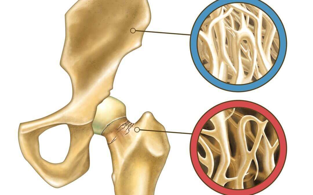 The Osteoporosis Crisis is Worse Than We Thought